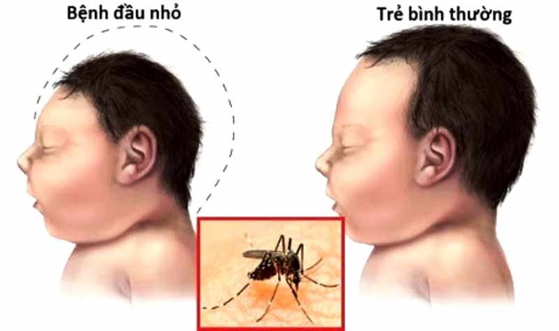 Không nên vì tâm lý mà đổ xô đến các cơ sở y tế làm xét nghiệm virus Zika