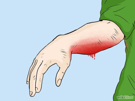 Gừng trị vết thương ngoài chảy máu: Lấy gừng nướng cháy nghiền thành bột, sau khi khử trùng vết thương, rắc lên vết thương, có thể làm giảm đau và cầm máu ngay lập tức.