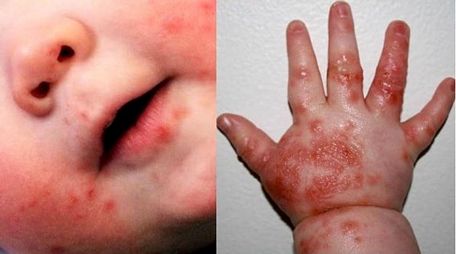 Trẻ bị tay chân miệng do virus EV71 gây ra có nguy cơ bị viêm não