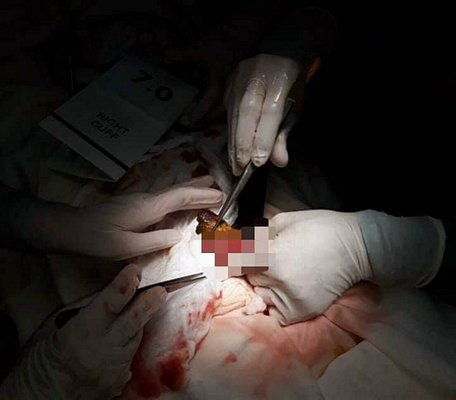 Các bác sĩ tiến hành phẫu thuật để đưa khối bã thức ăn ra ngoài - Ảnh: Bệnh viện cung cấp