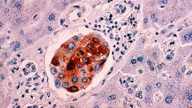 Hình ảnh về tế bào ung thư vú di căn tới gan. Ảnh: SCMP